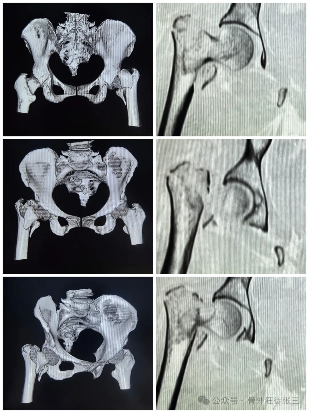 骨钩一钩定乾坤，85后高龄 ，速战速决，安全下台！