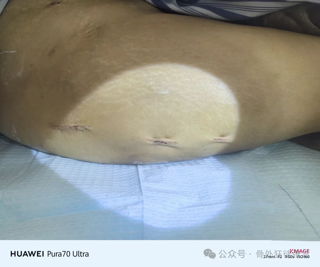 骨钩一钩定乾坤，85后高龄 ，速战速决，安全下台！