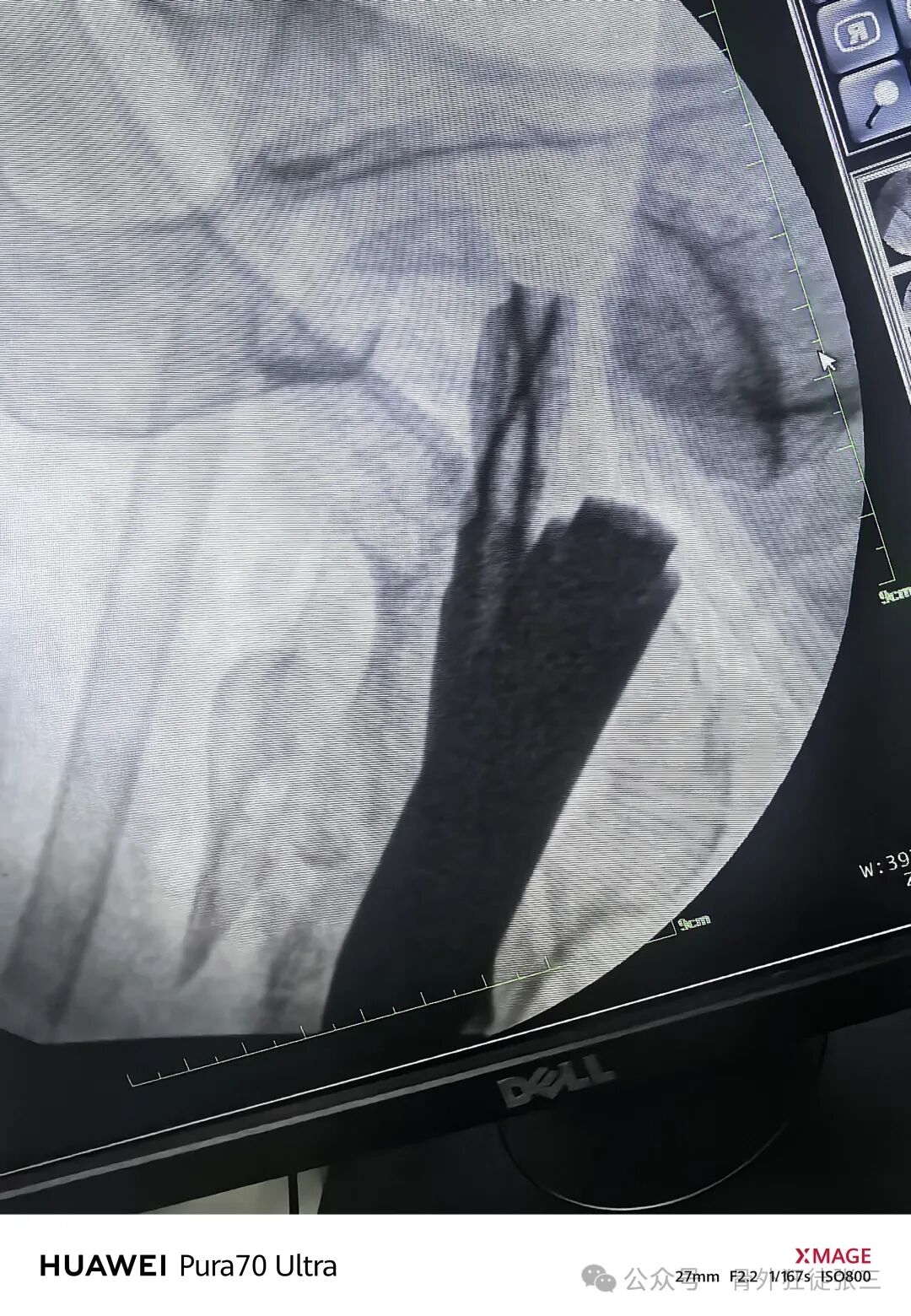 骨钩一钩定乾坤，85后高龄 ，速战速决，安全下台！