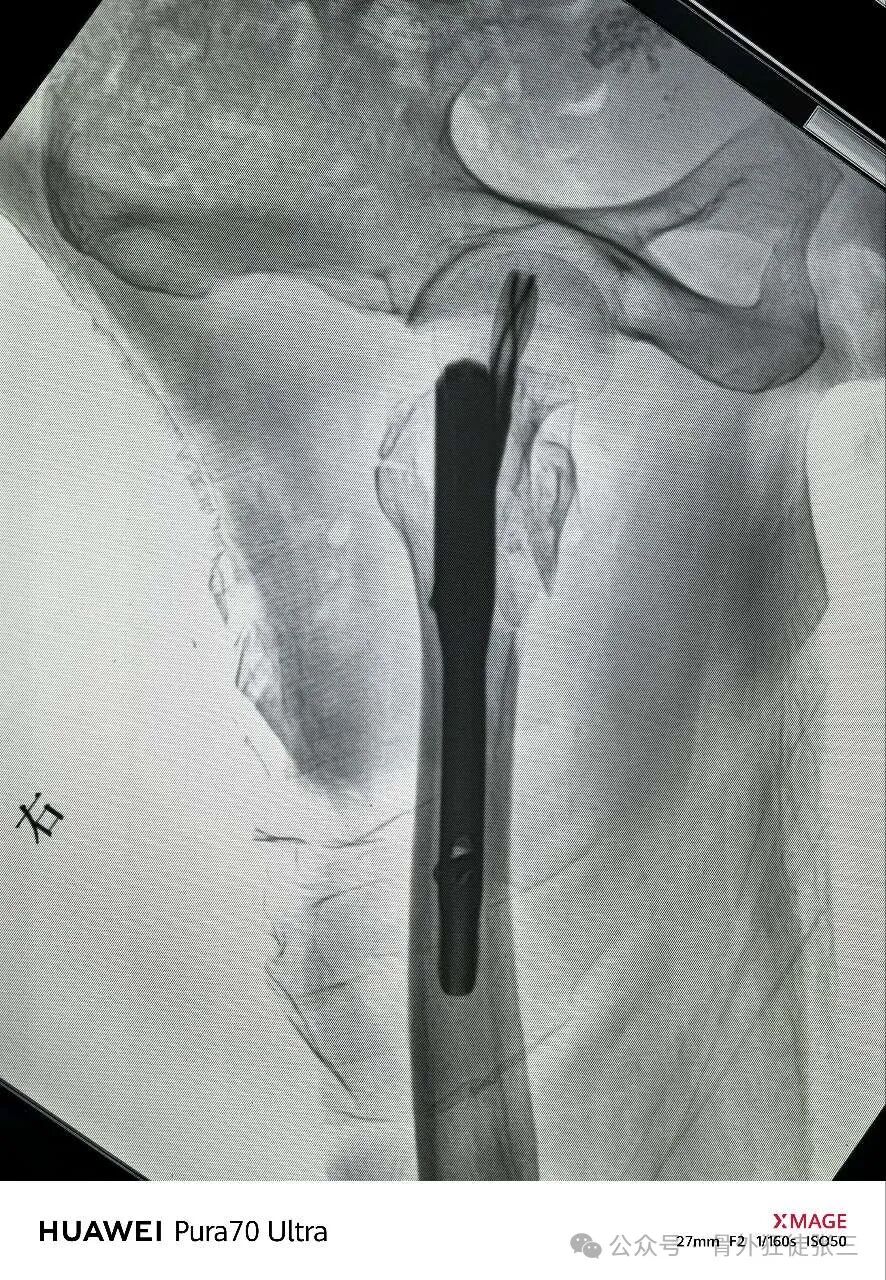 骨钩一钩定乾坤，85后高龄 ，速战速决，安全下台！