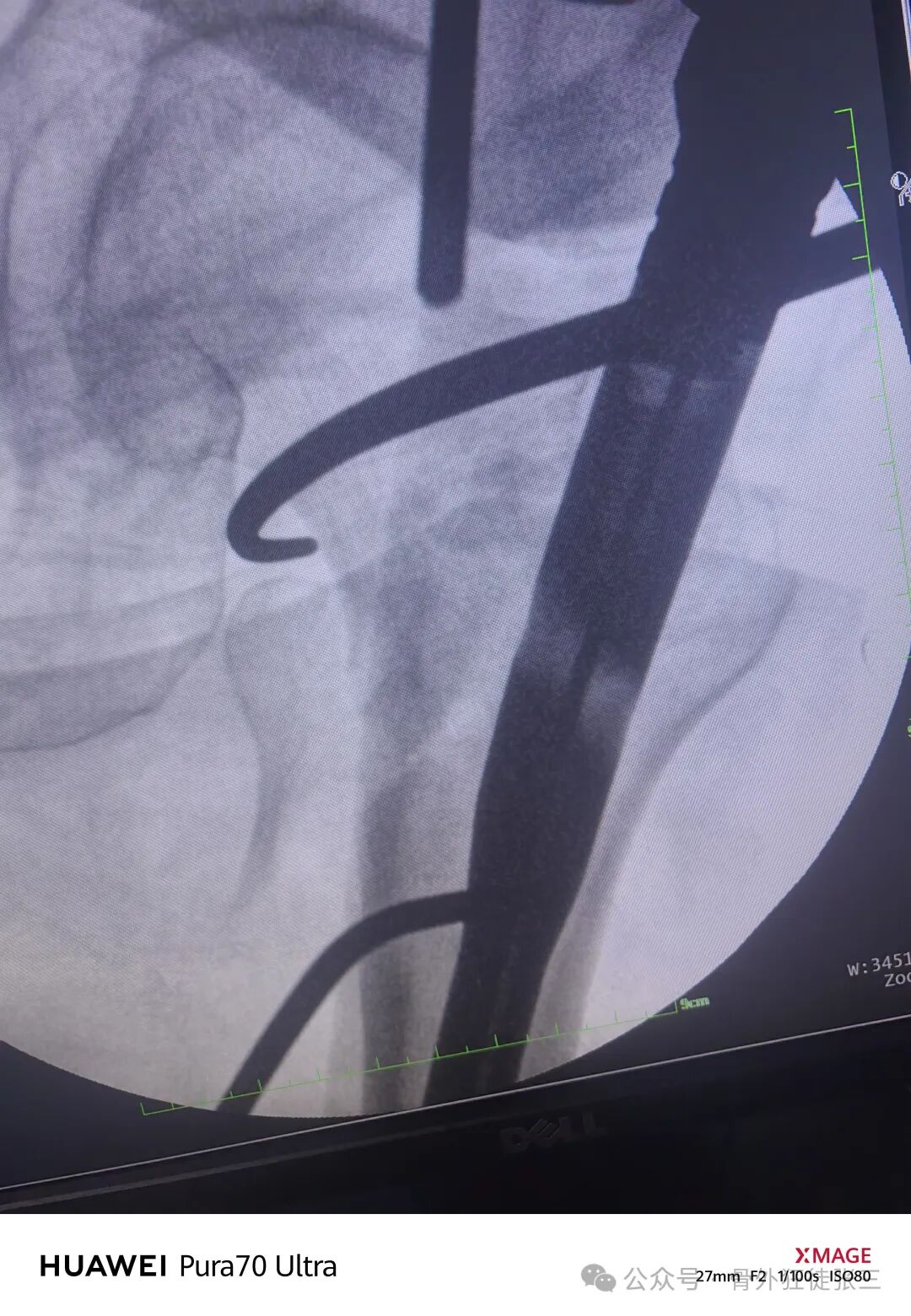 骨钩一钩定乾坤，85后高龄 ，速战速决，安全下台！