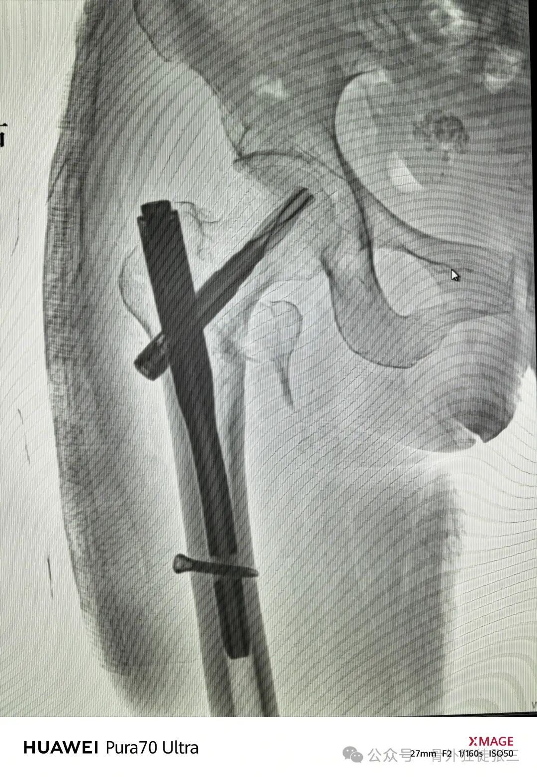 骨钩一钩定乾坤，85后高龄 ，速战速决，安全下台！