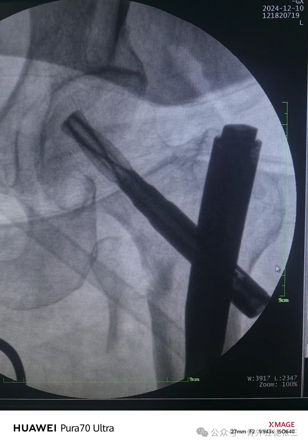 骨钩一钩定乾坤，85后高龄 ，速战速决，安全下台！