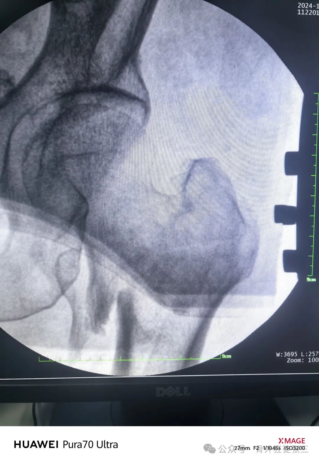 骨钩一钩定乾坤，85后高龄 ，速战速决，安全下台！
