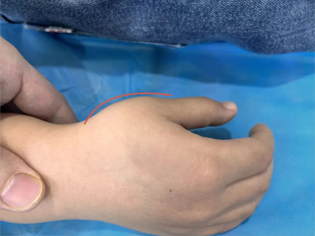 闭合复位治疗：儿童第