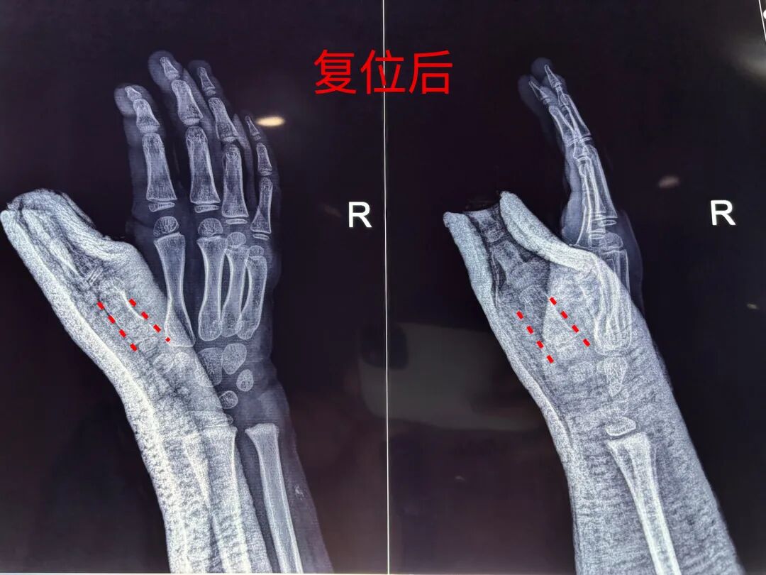 闭合复位治疗：儿童第