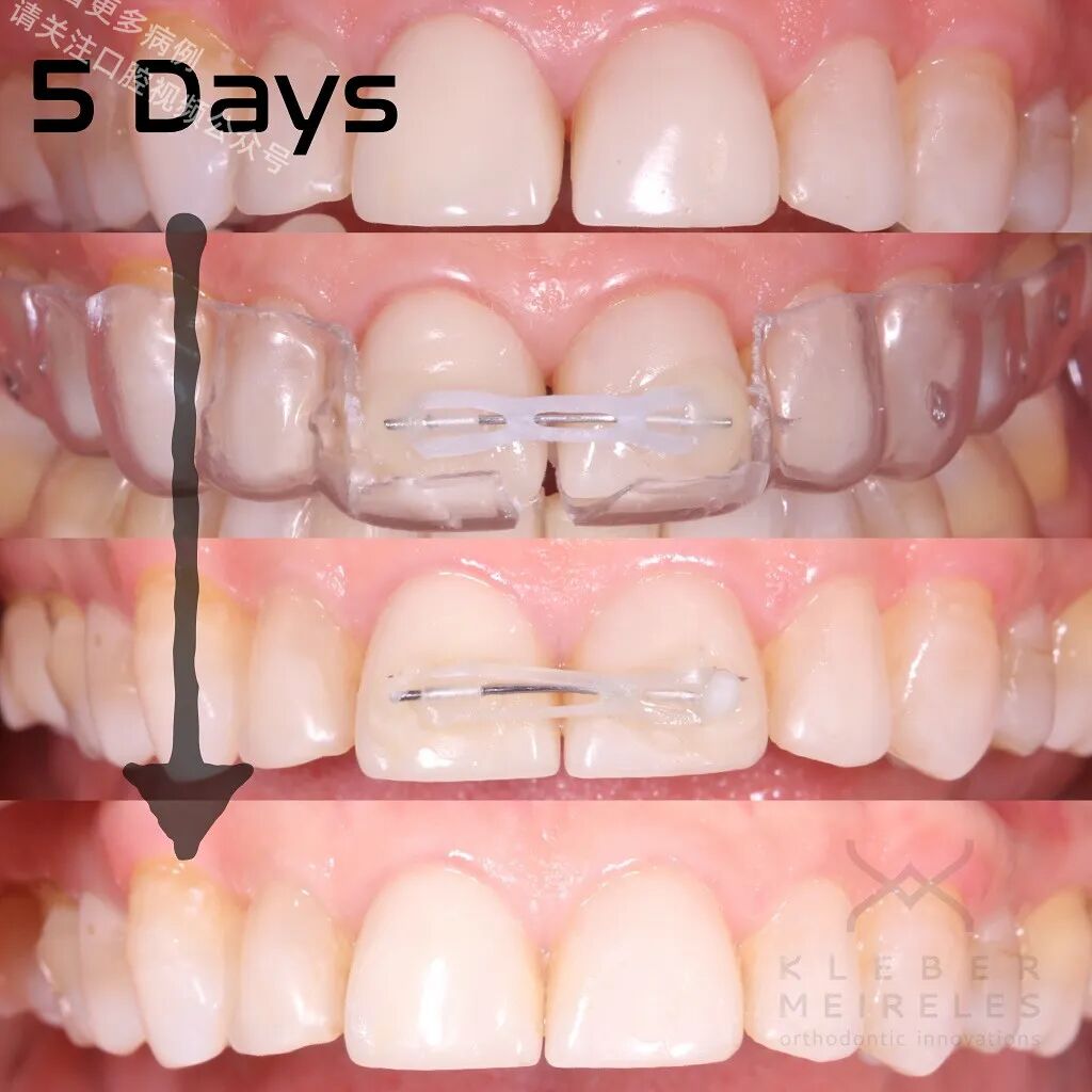 关闭间隙，还能这样做？