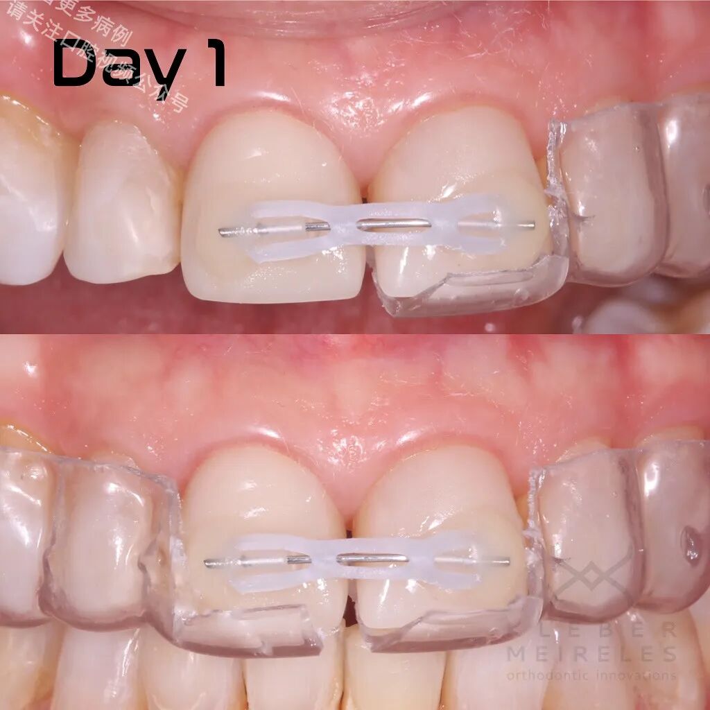 关闭间隙，还能这样做？