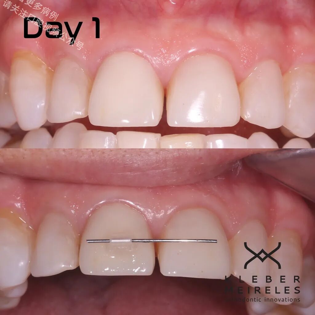 关闭间隙，还能这样做？