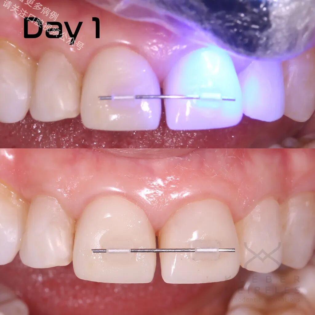 关闭间隙，还能这样做？