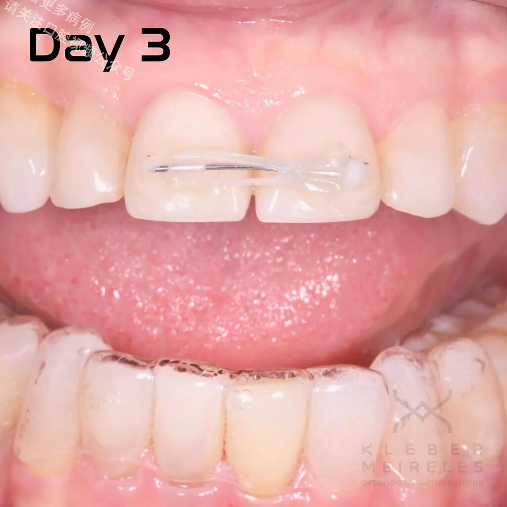 关闭间隙，还能这样做？