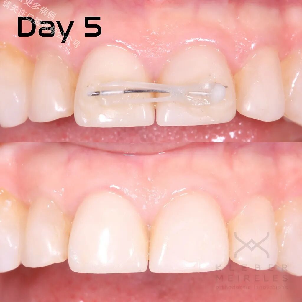 关闭间隙，还能这样做？