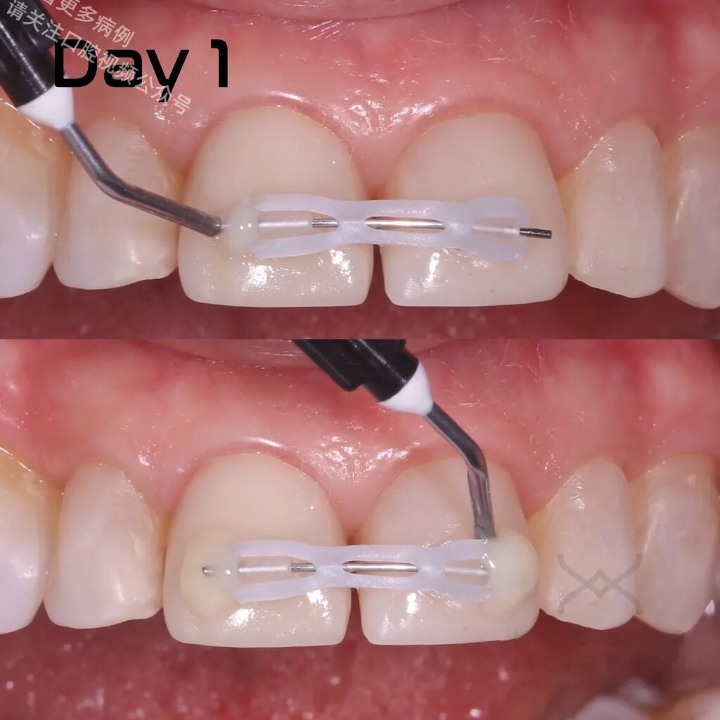 关闭间隙，还能这样做？