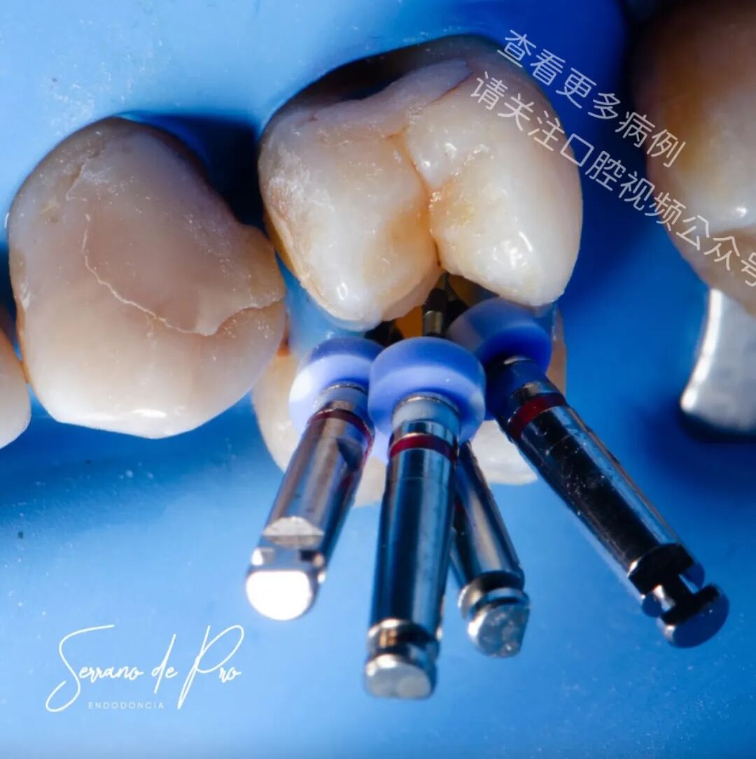 看一个非常奇特的根充病例