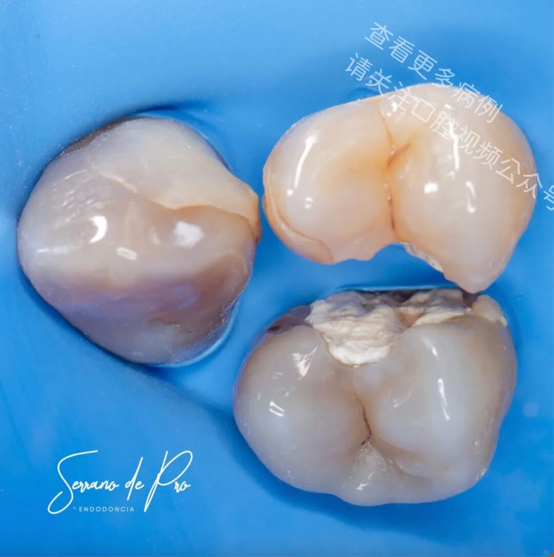 看一个非常奇特的根充病例