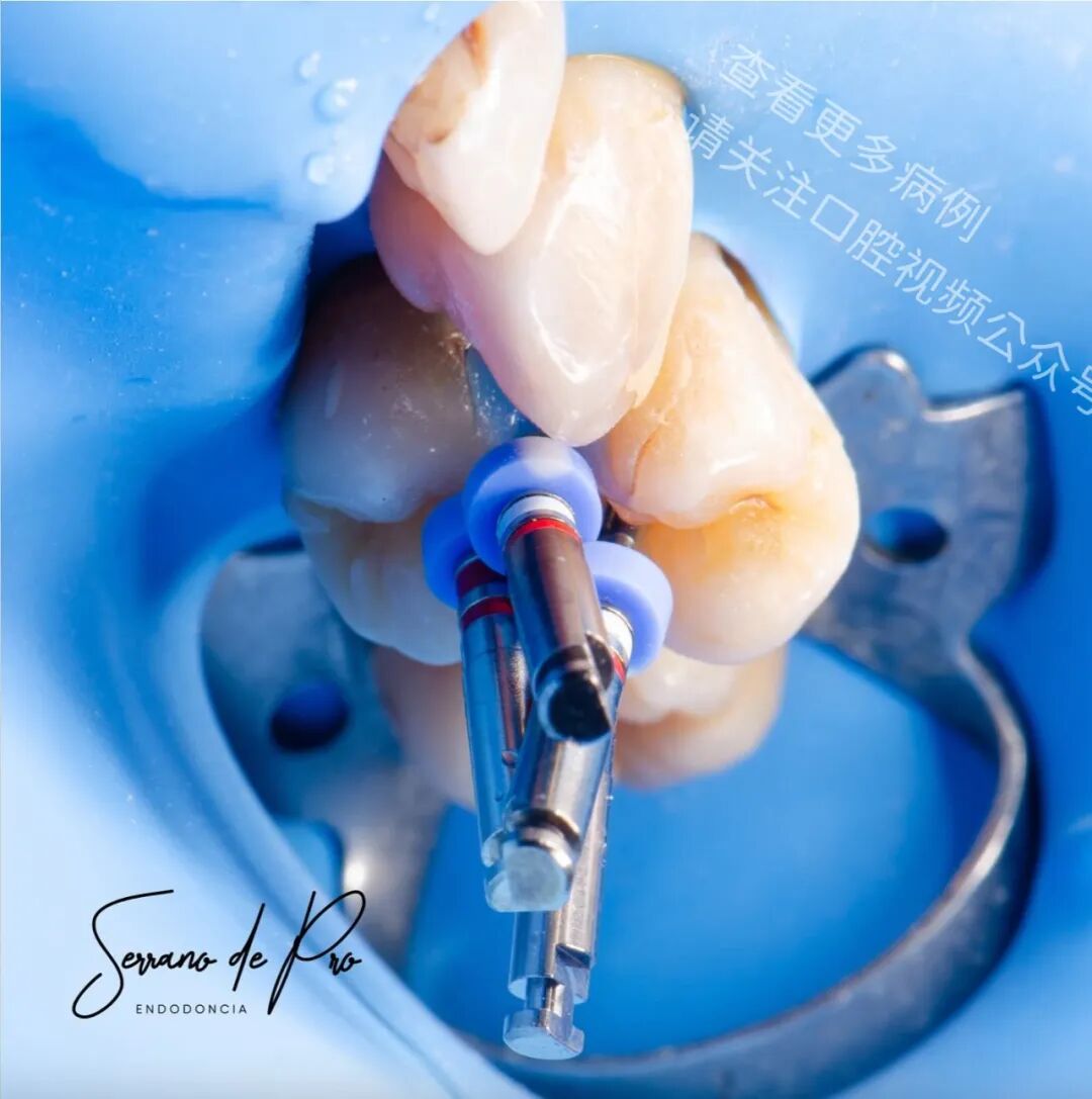 看一个非常奇特的根充病例