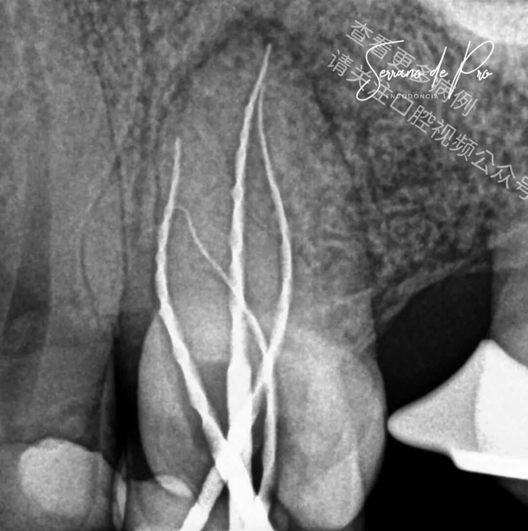 看一个非常奇特的根充病例