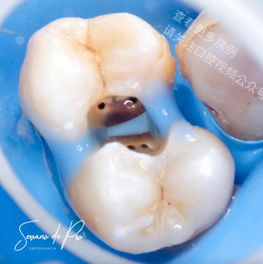 看一个非常奇特的根充病例