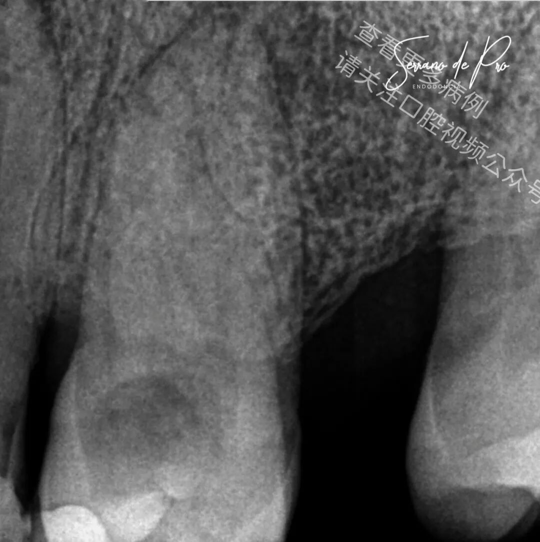 看一个非常奇特的根充病例