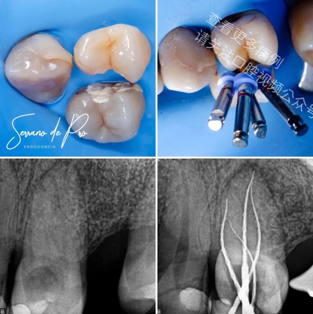 看一个非常奇特的根充病例