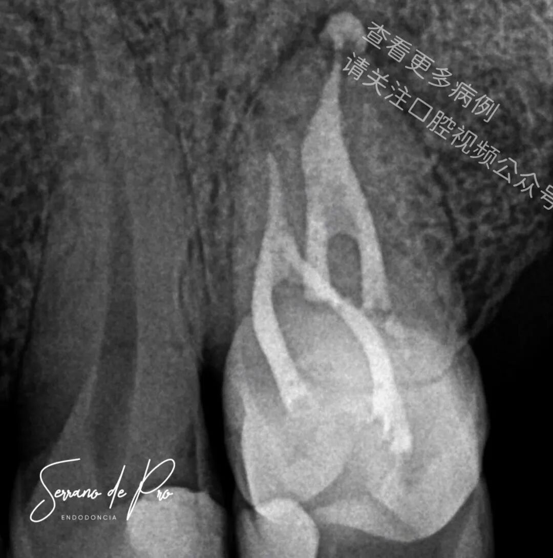 看一个非常奇特的根充病例