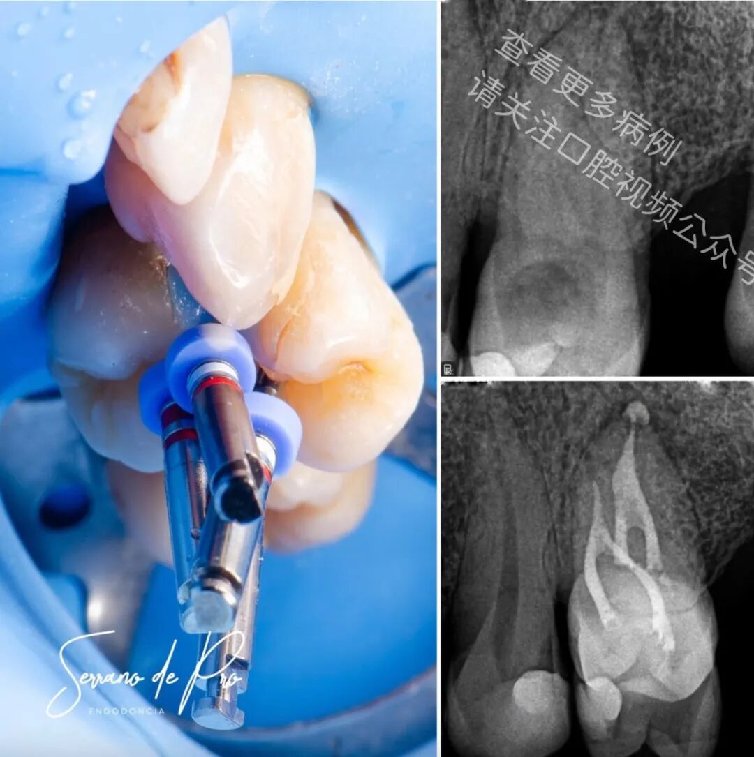 看一个非常奇特的根充病例
