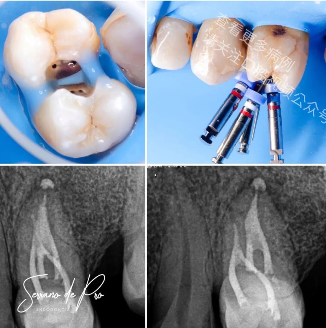 看一个非常奇特的根充病例