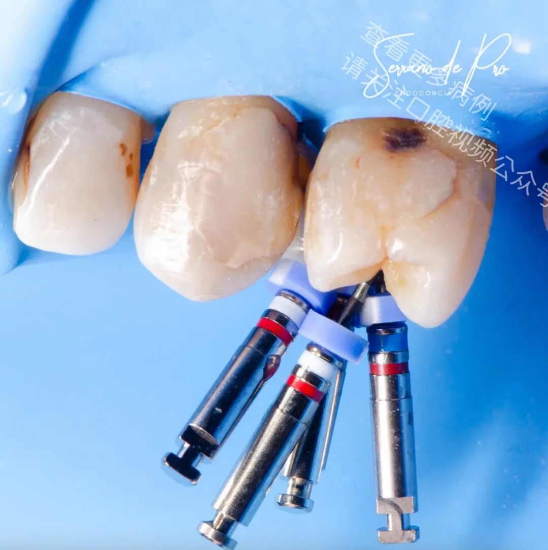 看一个非常奇特的根充病例