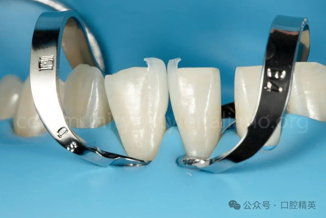 下前牙关闭间隙；不备牙瓷贴面修复