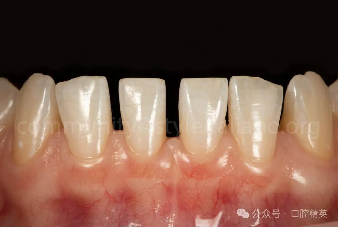 下前牙关闭间隙；不备牙瓷贴面修复