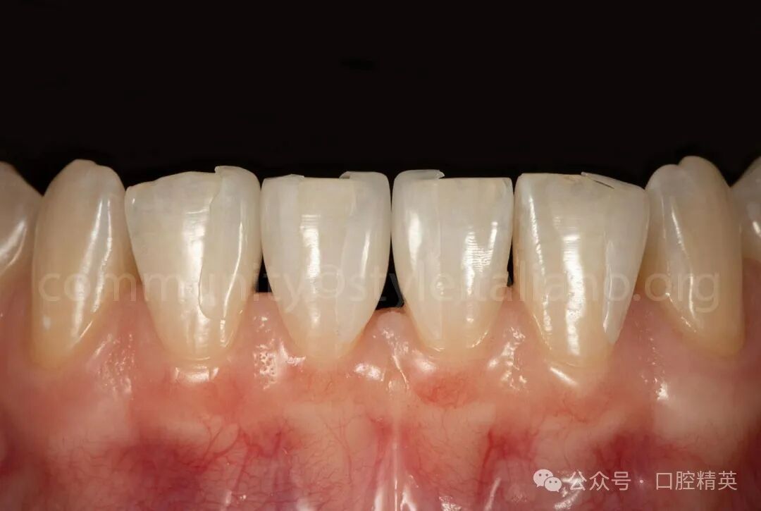 下前牙关闭间隙；不备牙瓷贴面修复