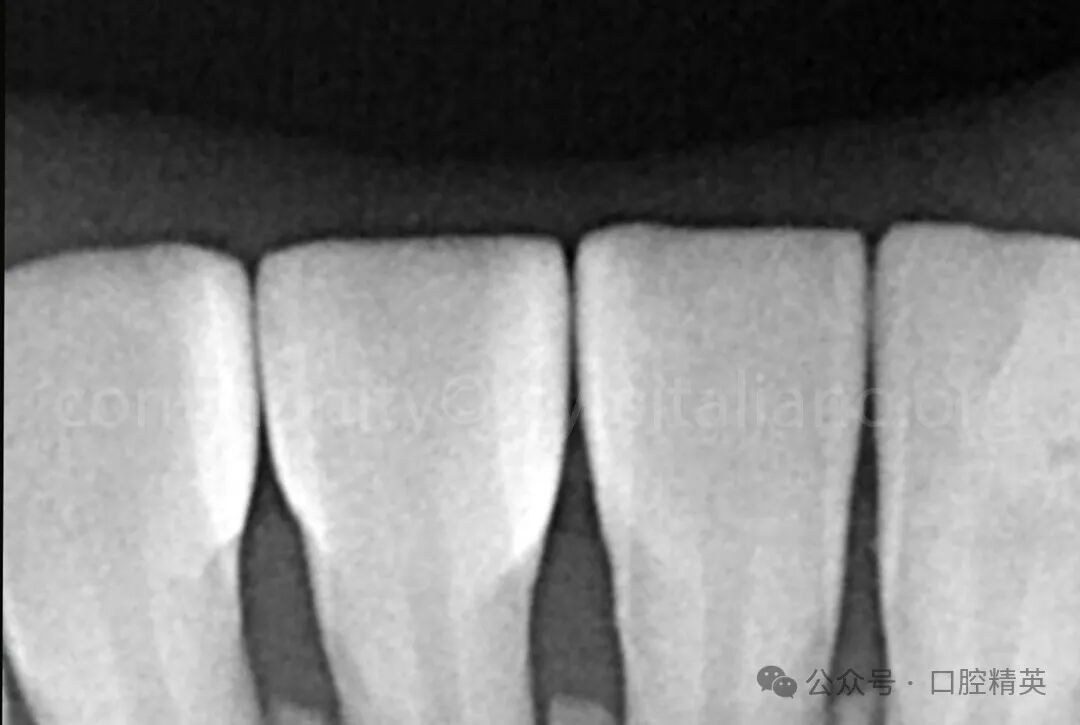 下前牙关闭间隙；不备牙瓷贴面修复