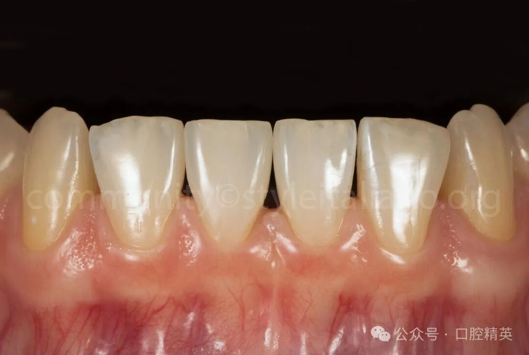 下前牙关闭间隙；不备牙瓷贴面修复
