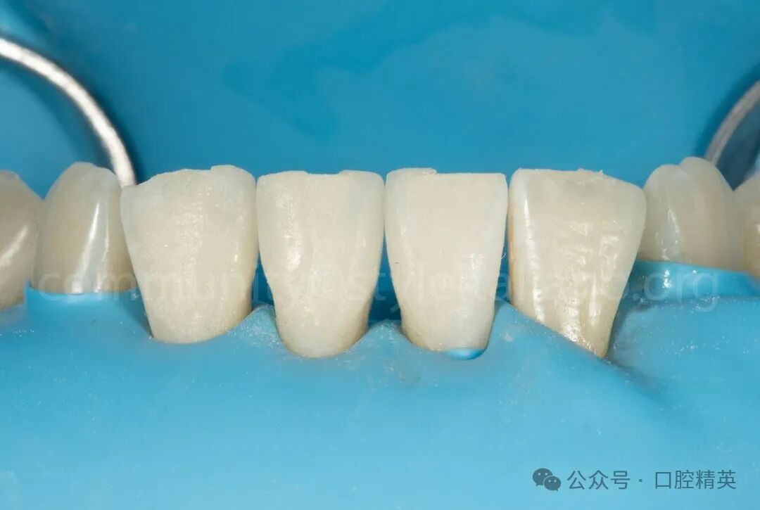 下前牙关闭间隙；不备牙瓷贴面修复