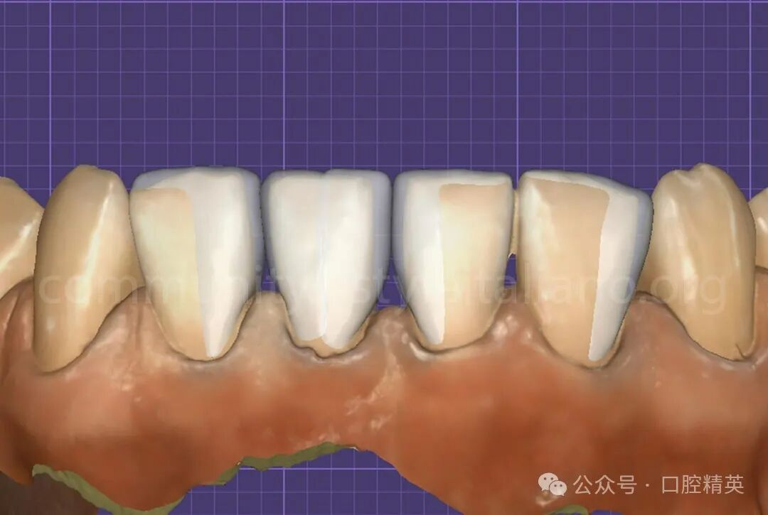 下前牙关闭间隙；不备牙瓷贴面修复