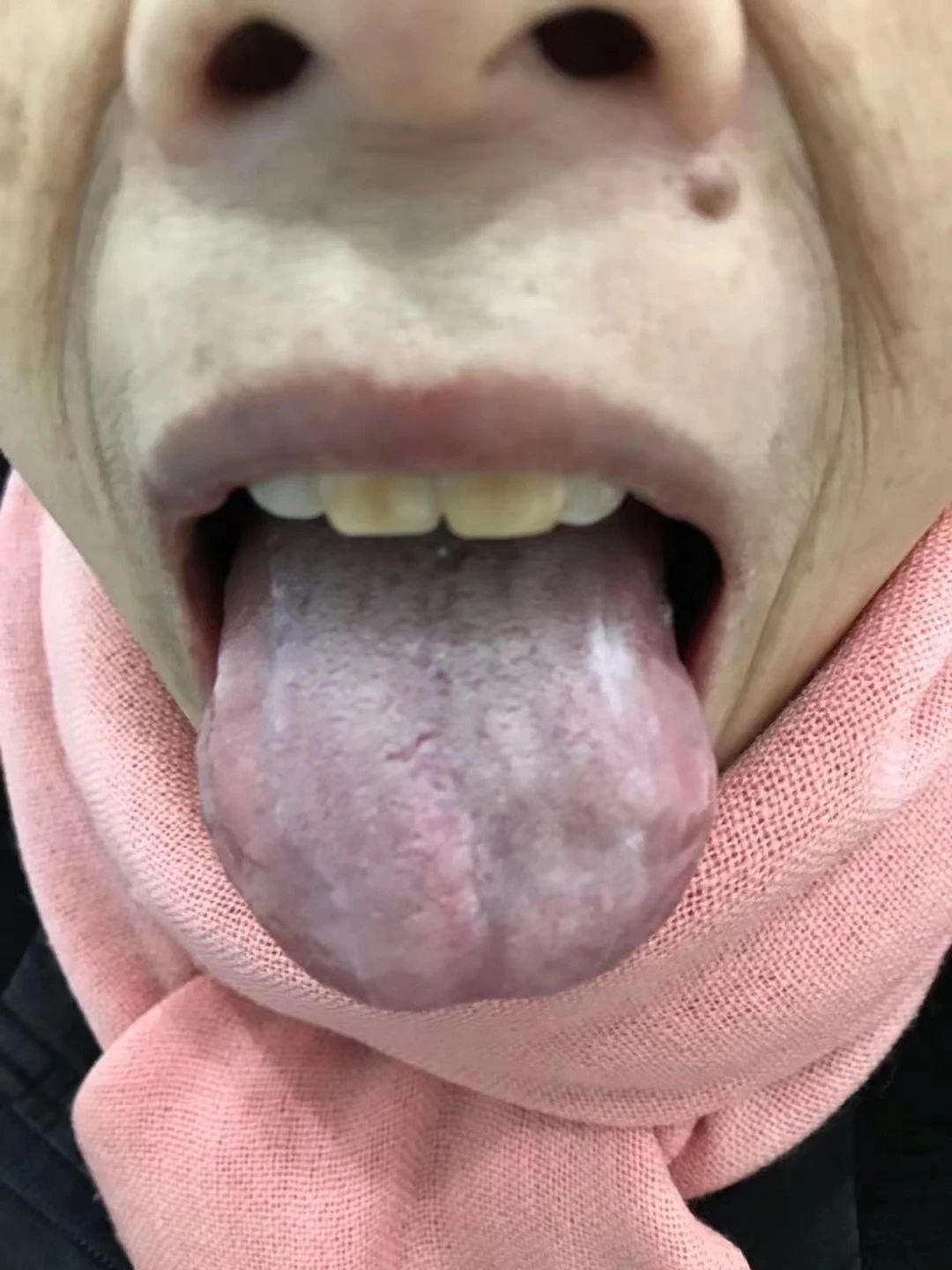 舌头上长色斑是什么原因