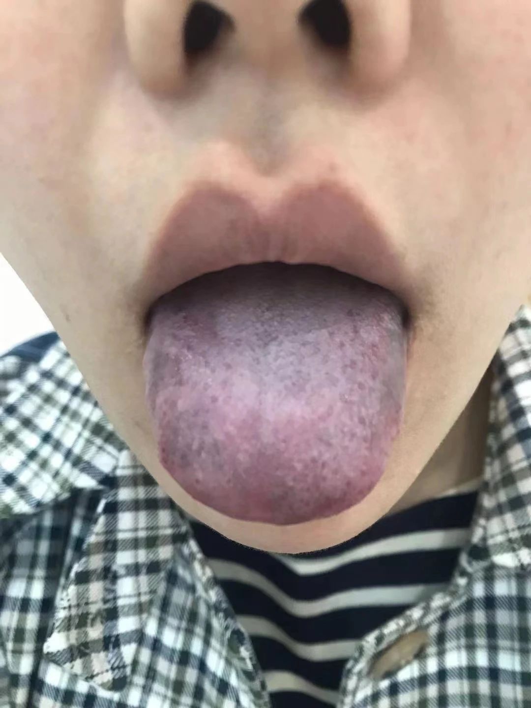 舌头上长色斑是什么原因