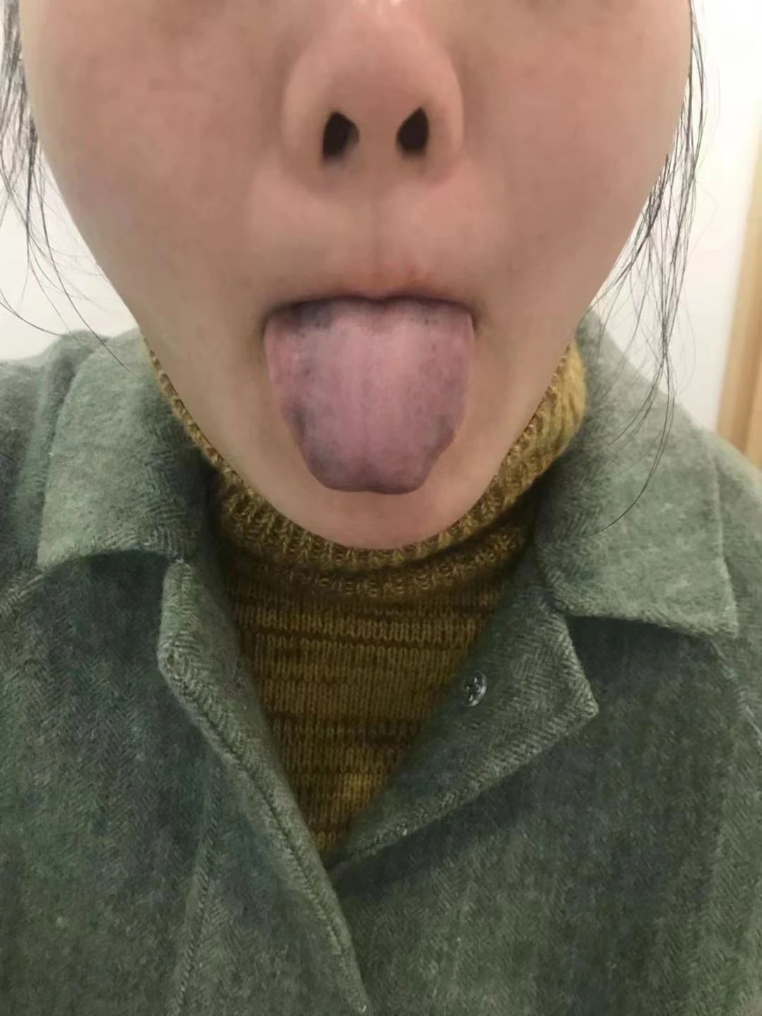 舌头上长色斑是什么原因