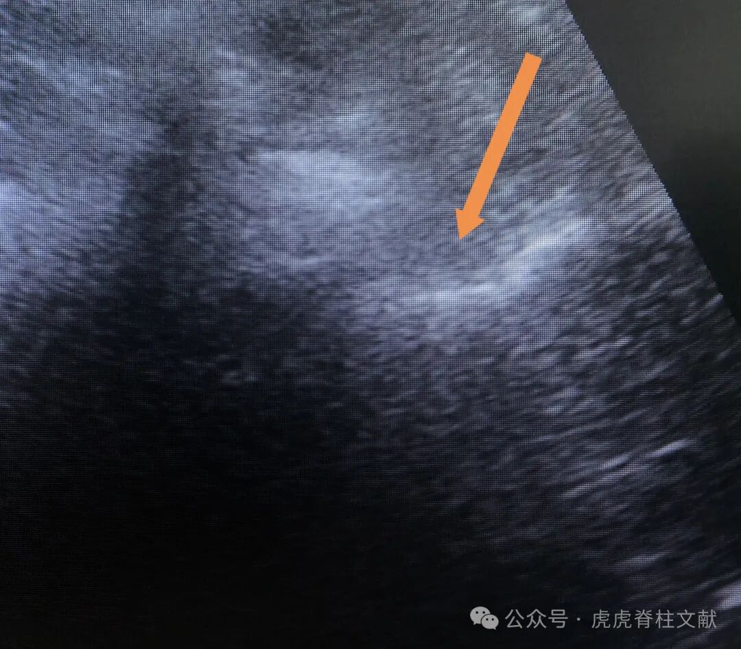 超声引导下腰5骶1椎间孔穿刺法示意图（斜短轴平面内穿刺法）