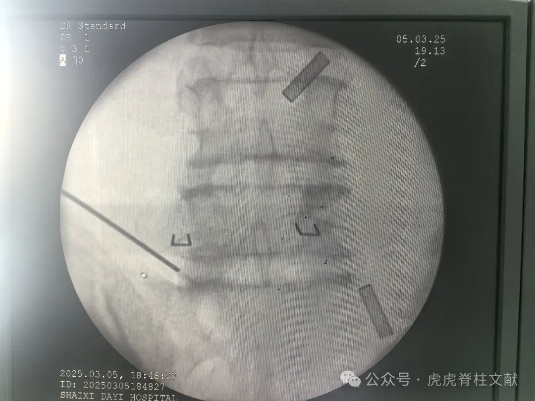 超声引导下腰5骶1椎间孔穿刺法示意图（斜短轴平面内穿刺法）