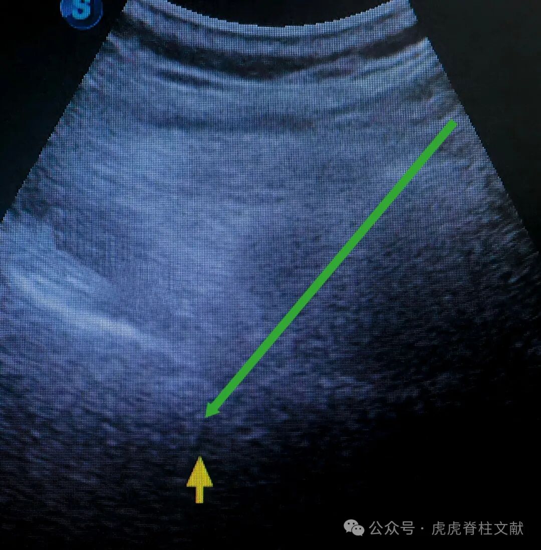 超声引导下腰5骶1椎间孔穿刺法示意图（斜短轴平面内穿刺法）