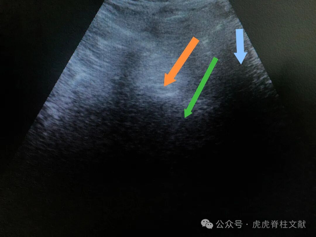 超声引导下腰5骶1椎间孔穿刺法示意图（斜短轴平面内穿刺法）
