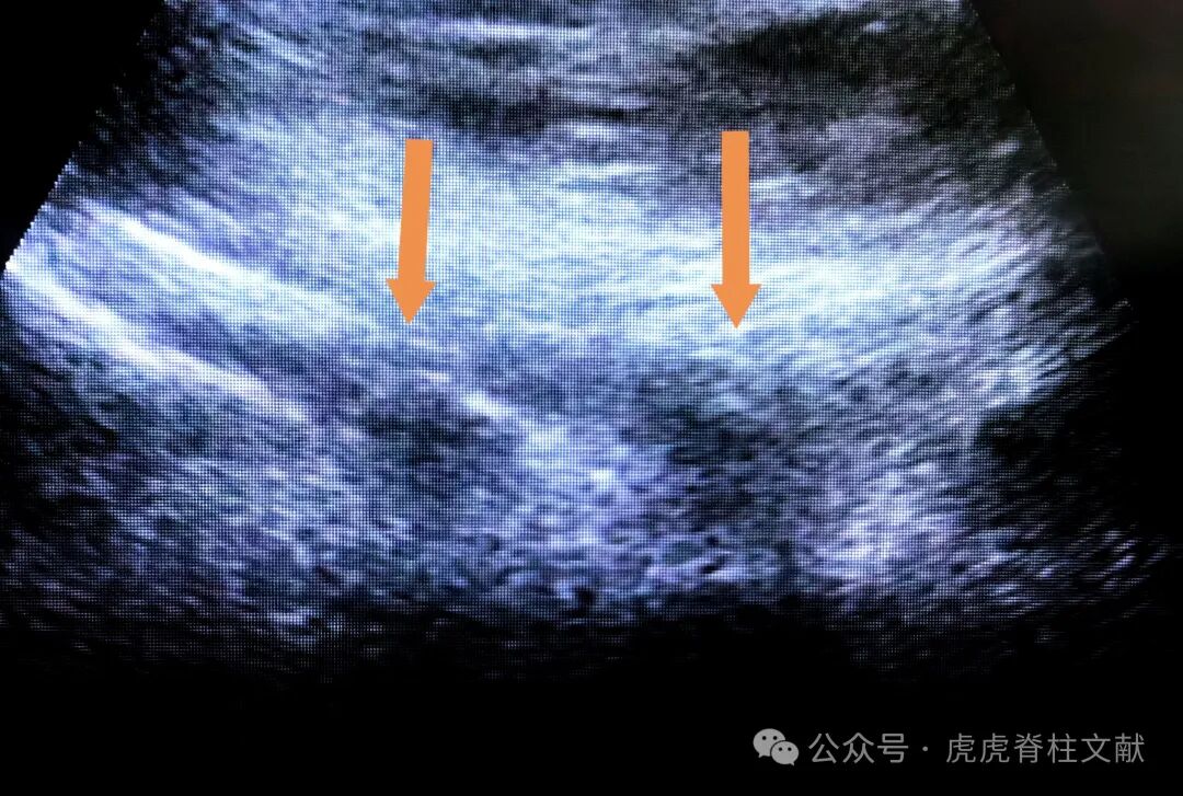 超声引导下腰5骶1椎间孔穿刺法示意图（斜短轴平面内穿刺法）