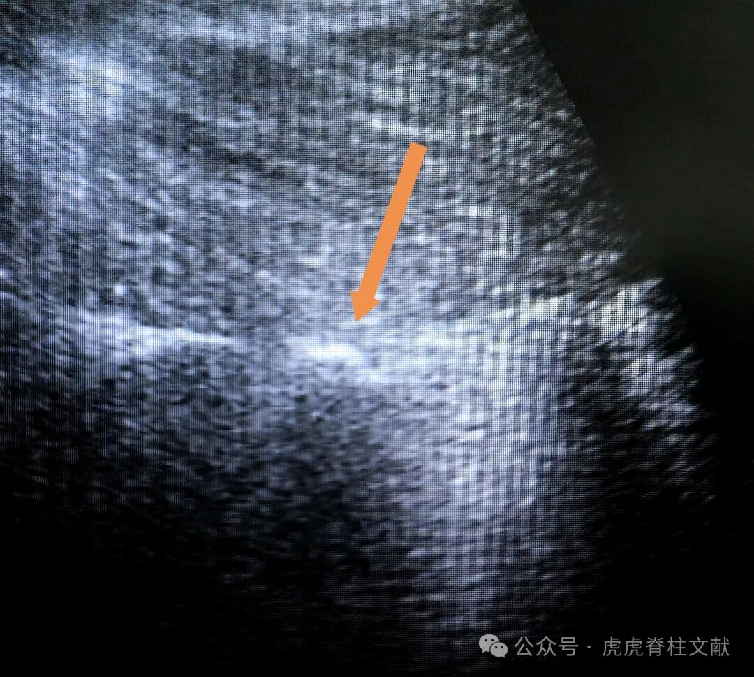 超声引导下腰5骶1椎间孔穿刺法示意图（斜短轴平面内穿刺法）
