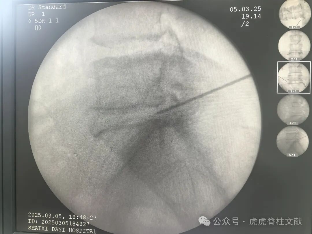 超声引导下腰5骶1椎间孔穿刺法示意图（斜短轴平面内穿刺法）