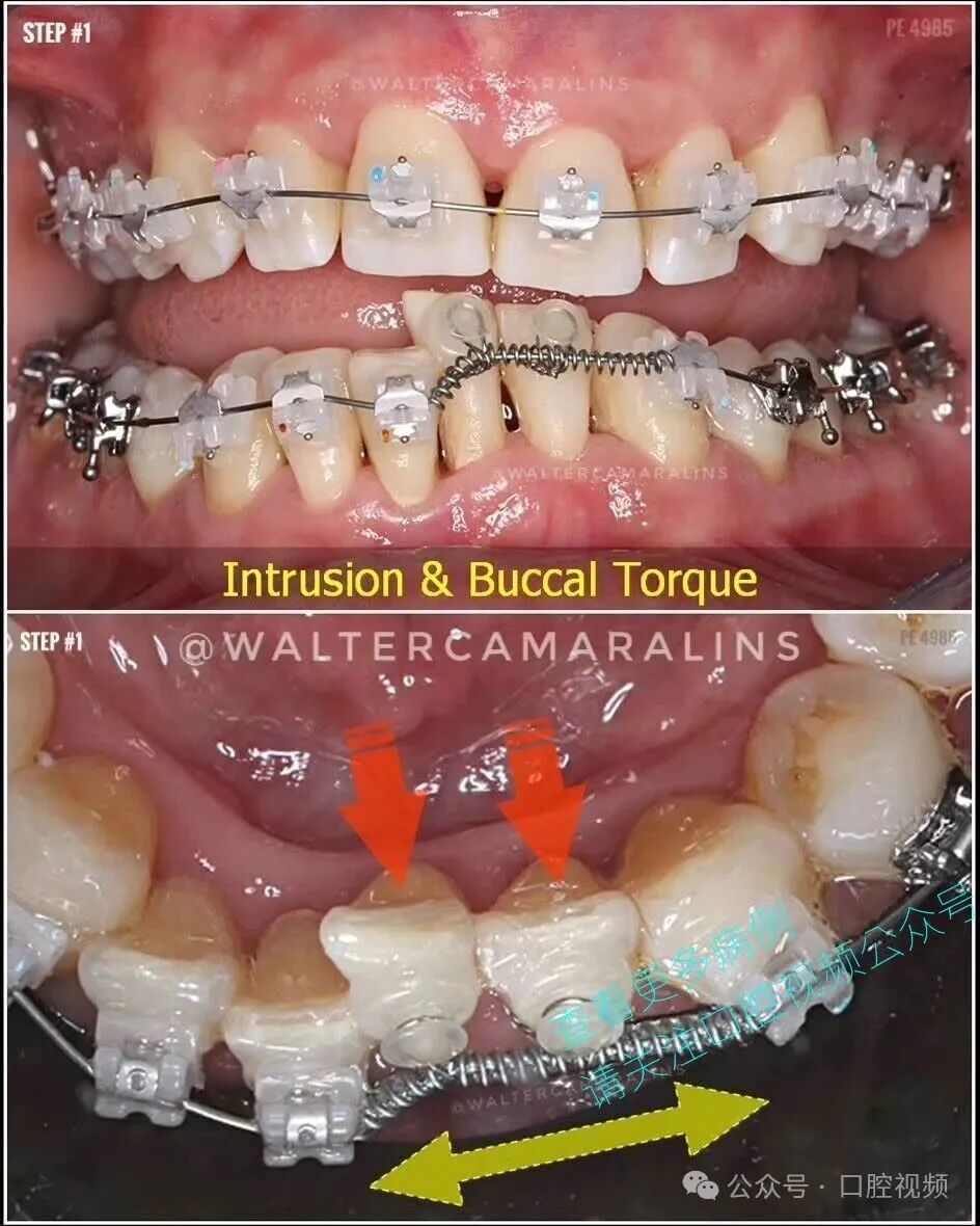 这样的正畸，该怎么收费