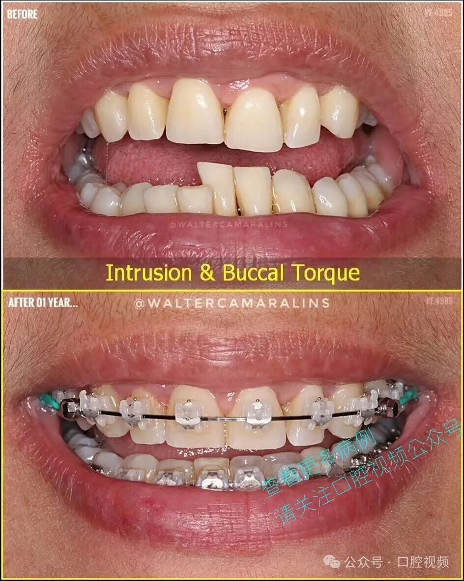 这样的正畸，该怎么收费