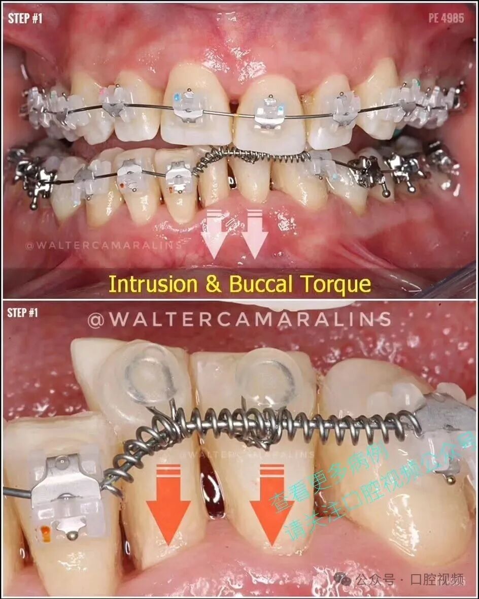 这样的正畸，该怎么收费