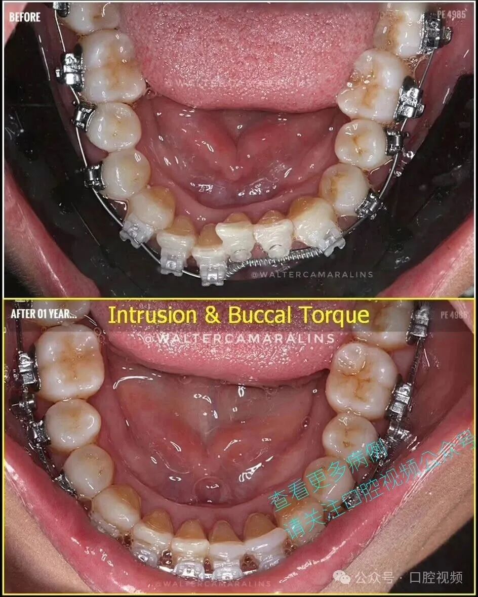 这样的正畸，该怎么收费