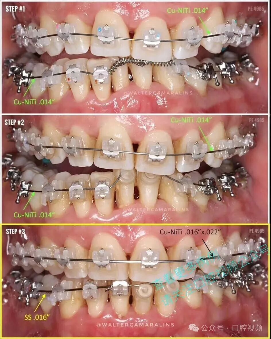 这样的正畸，该怎么收费